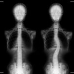 Unraveling Scoliosis: A Comprehensive Guide to Spinal Health 
