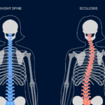 Understanding Adolescent Idiopathic Scoliosis Correction