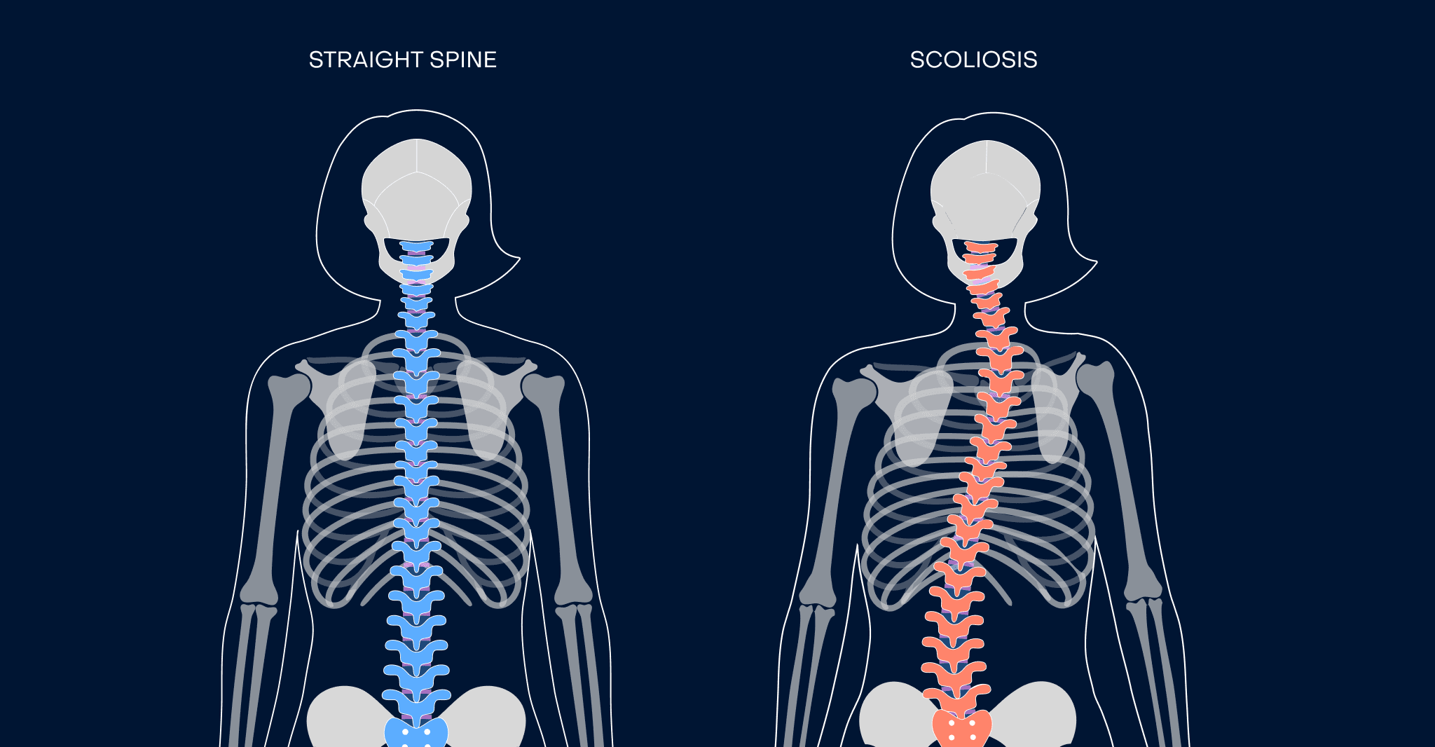 Expert Insights on Scoliosis Correction and Treatment