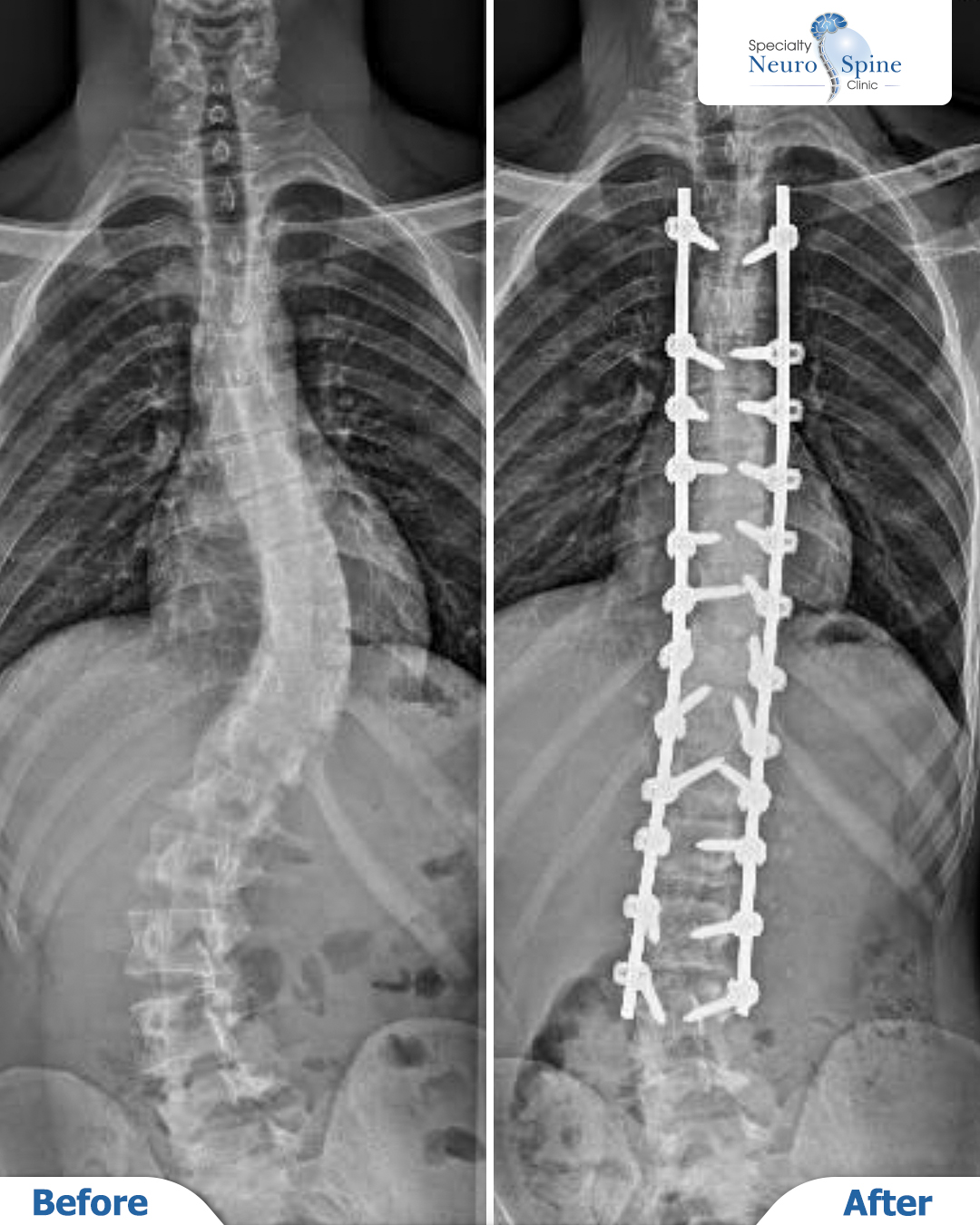 عملية تصحيح انحراف العمود الفقري