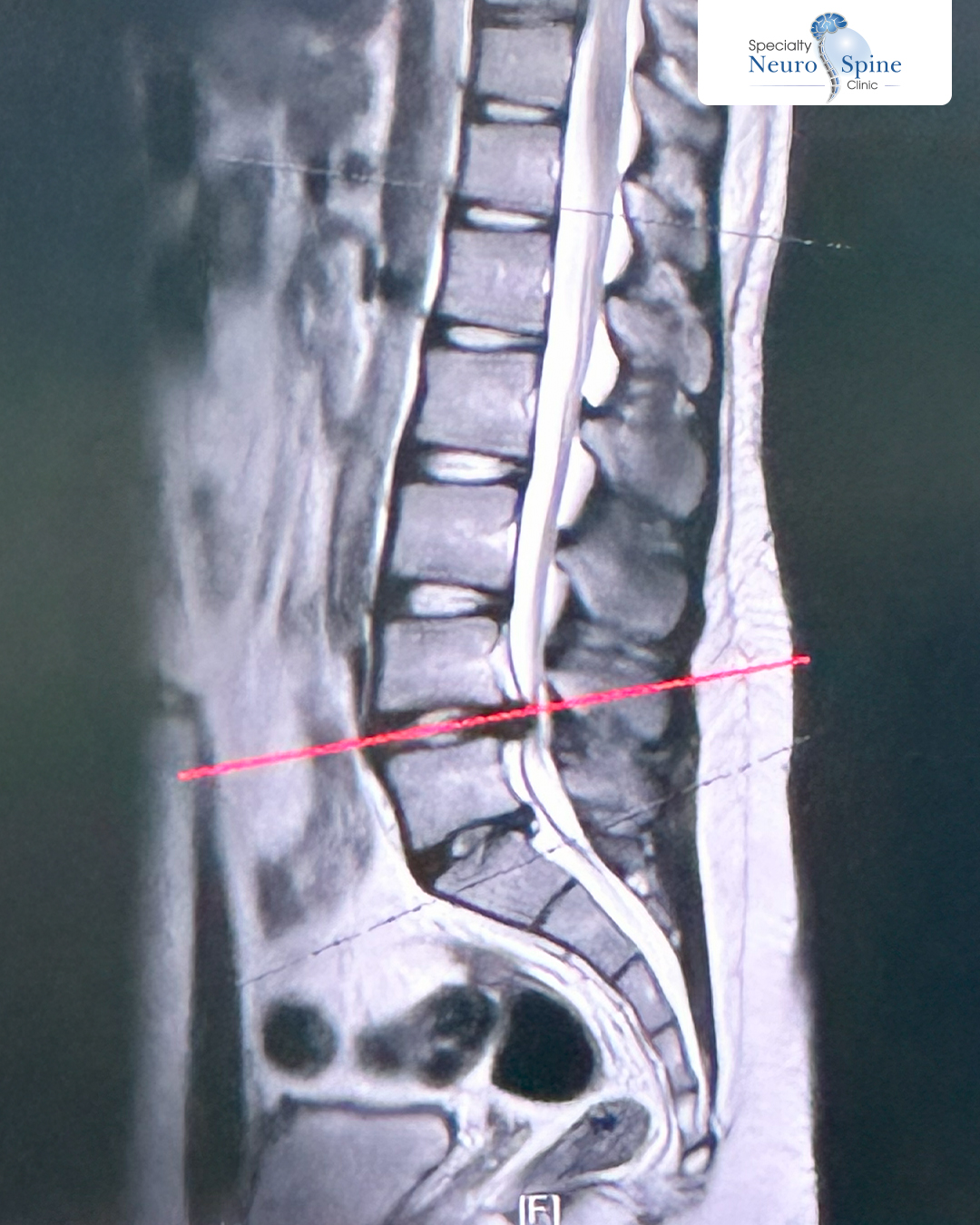 انزلاق غضروفي