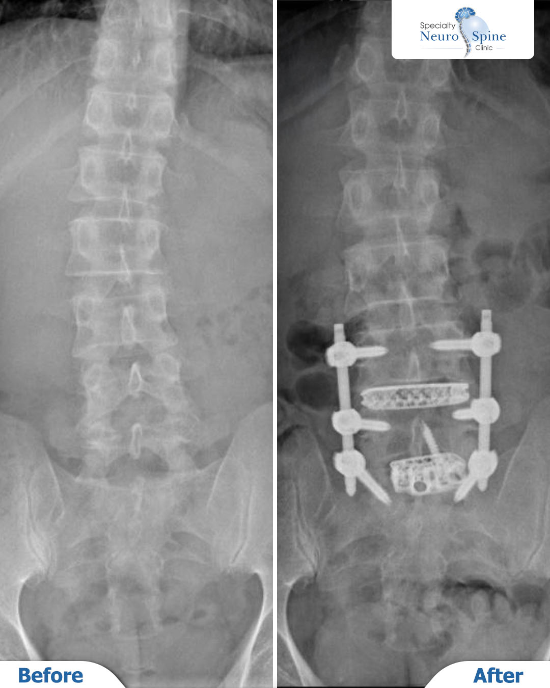 ازالة الانزلاق الغضروفي