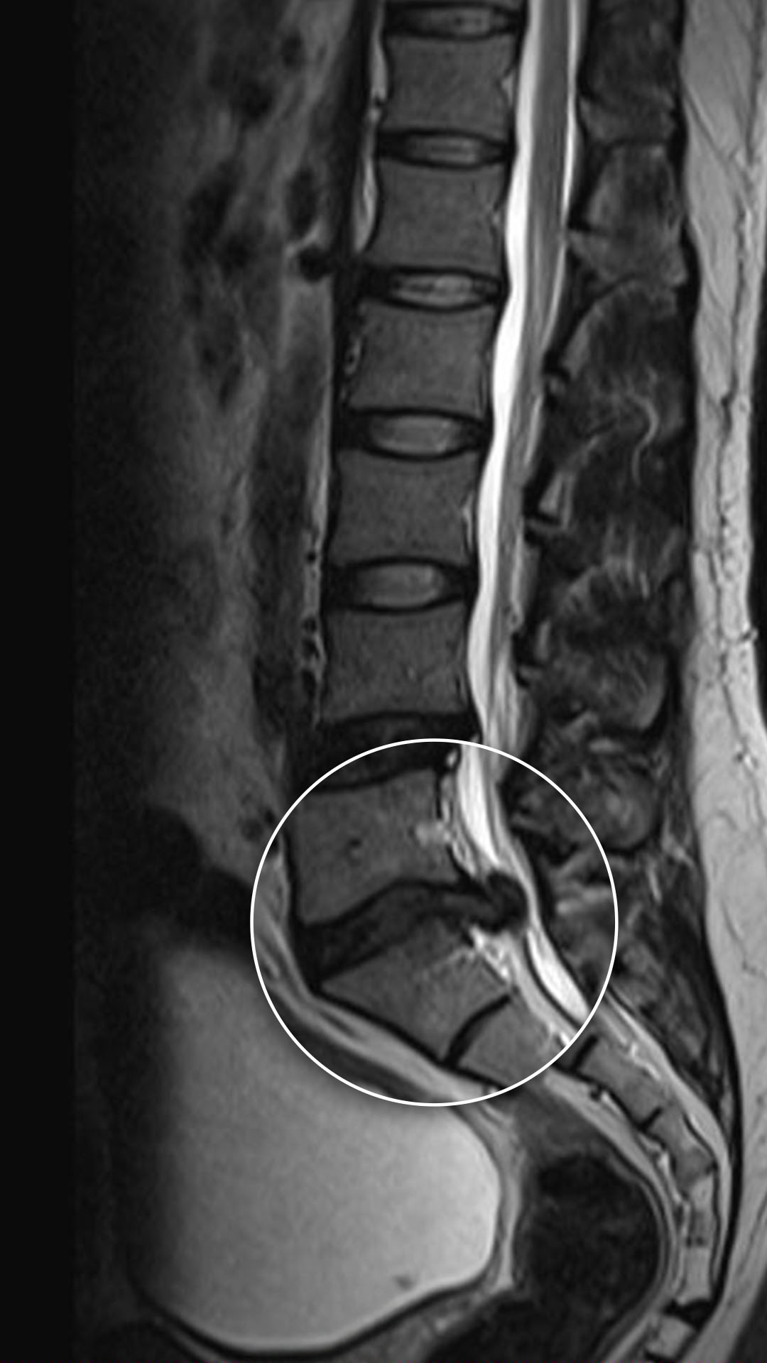 عملية إزالة الانزلاق الغضروفي وتحرير الضغط عن العصب